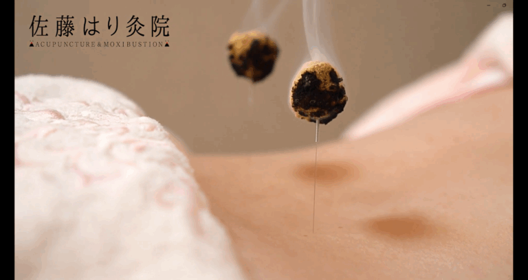 灸頭鍼